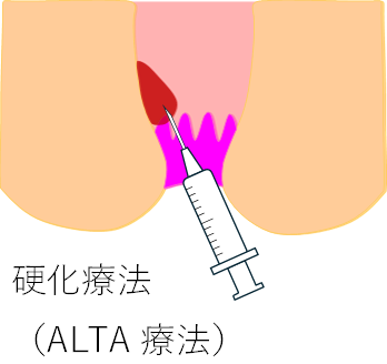 いぼじ