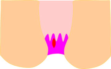 切れ痔